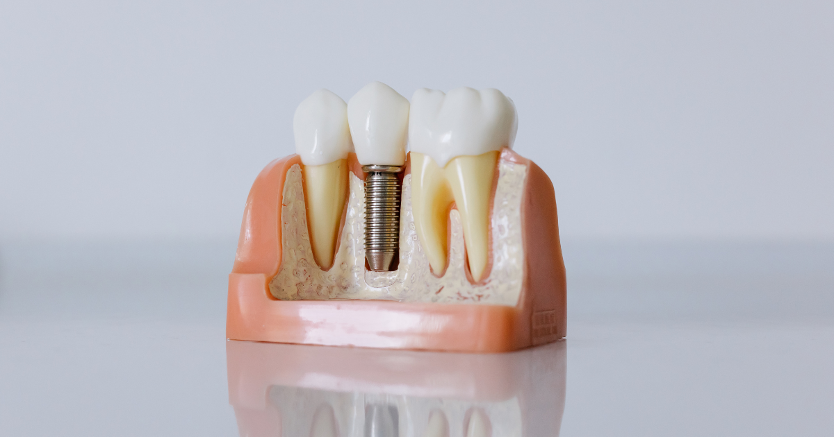 dental implants services at Torresdale Dental Associates