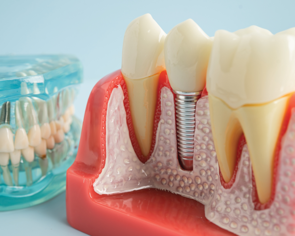 dental implants model