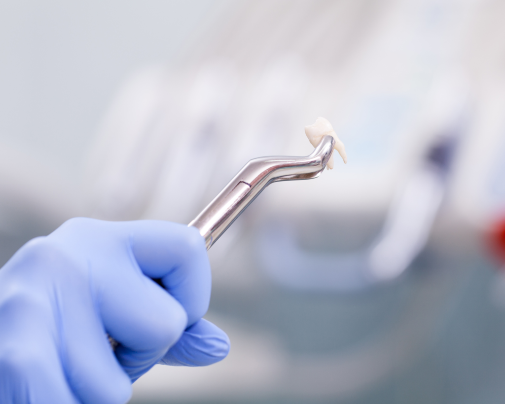 could you need a tooth extraction?