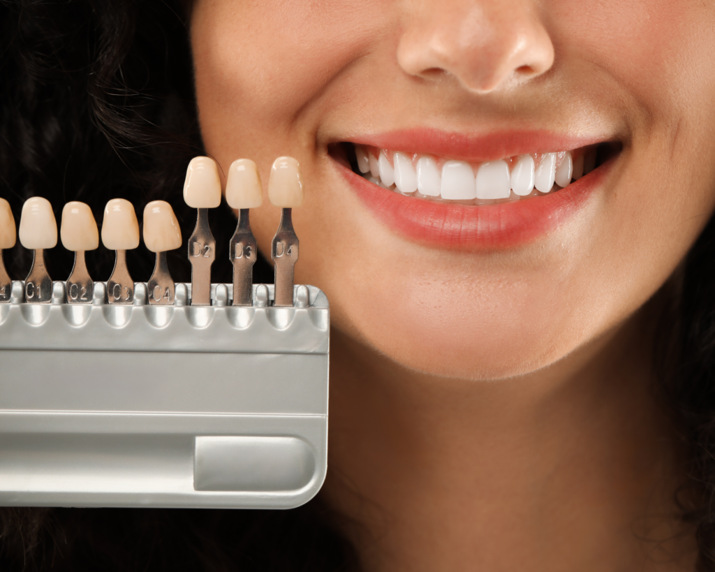 veneers (1)