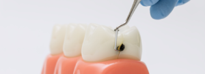 what is a dental cavity