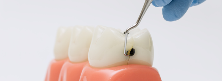 what is a dental cavity